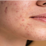 Skin Barrier Repair