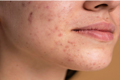 Skin Barrier Repair